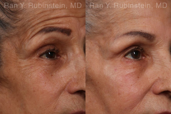 Botox Before and After Photos in Montvale, NJ, Patient 17907
