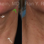 Botox Before and After Photos in Montvale, NJ, Patient 17908