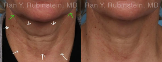 Botox Before and After Photos in Montvale, NJ, Patient 17908