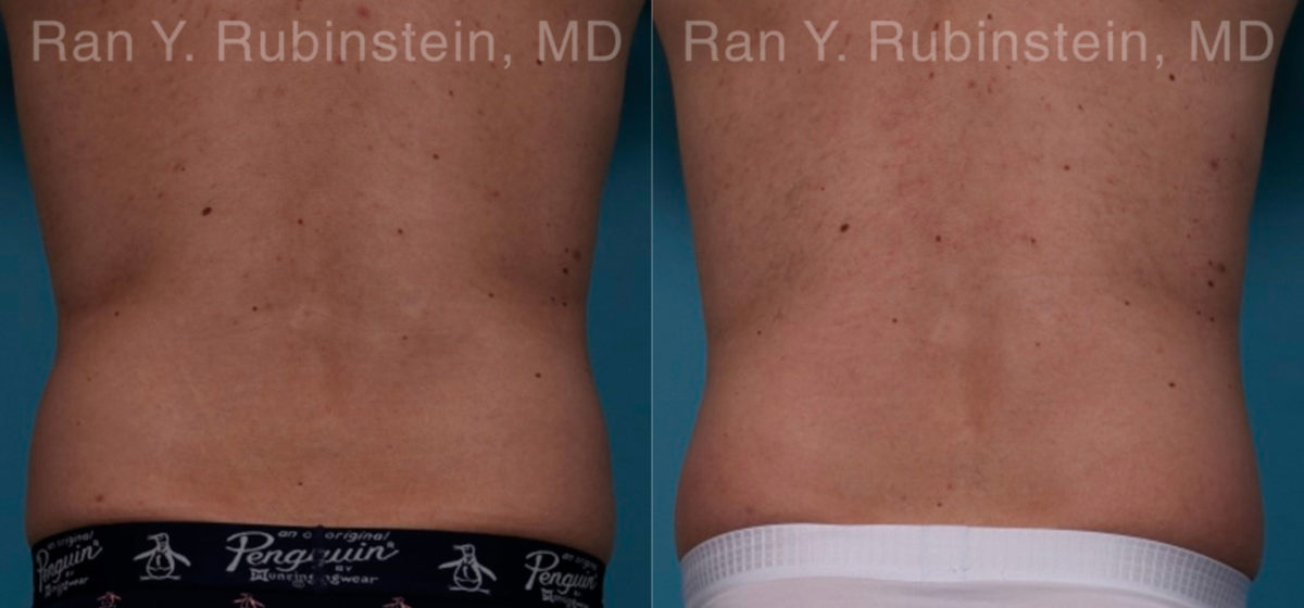 Coolsculpting Elite Before and After Photos in Montvale, NJ, Patient 18079