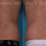 Coolsculpting Elite Before and After Photos in Montvale, NJ, Patient 18079