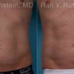 Coolsculpting Elite Before and After Photos in Montvale, NJ, Patient 18079