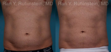 Coolsculpting Elite Before and After Photos in Montvale, NJ, Patient 18079