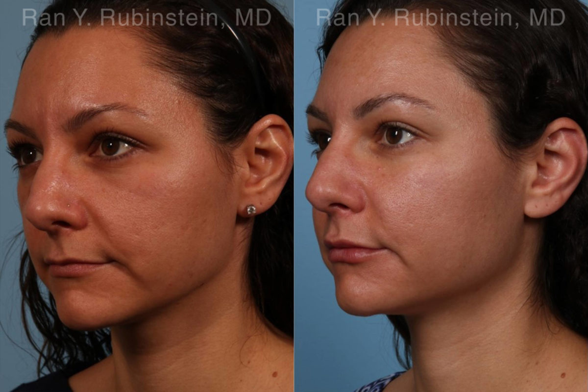 Sculptra Face Before and After Photos in Montvale, NJ, Patient 18419