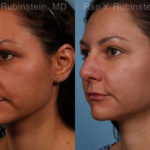 Sculptra Face Before and After Photos in Montvale, NJ, Patient 18419
