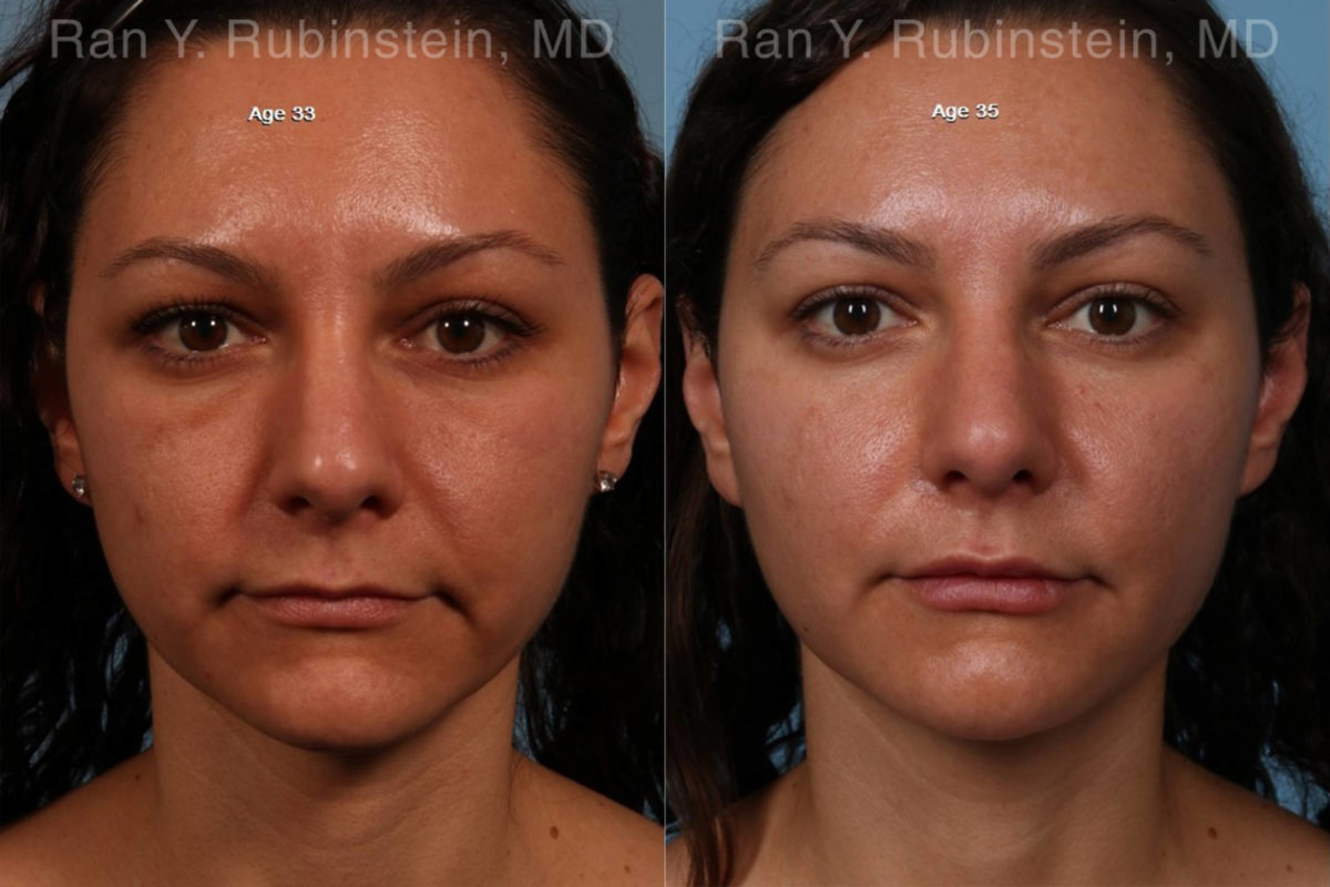 Sculptra Face Before and After Photos in Montvale, NJ, Patient 18419