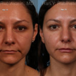 Sculptra Face Before and After Photos in Montvale, NJ, Patient 18419
