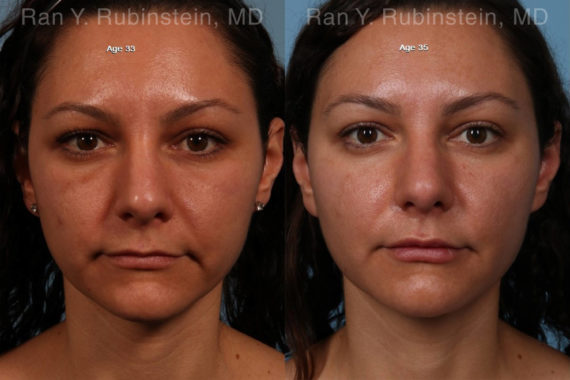 Sculptra Face Before and After Photos in Montvale, NJ, Patient 18419