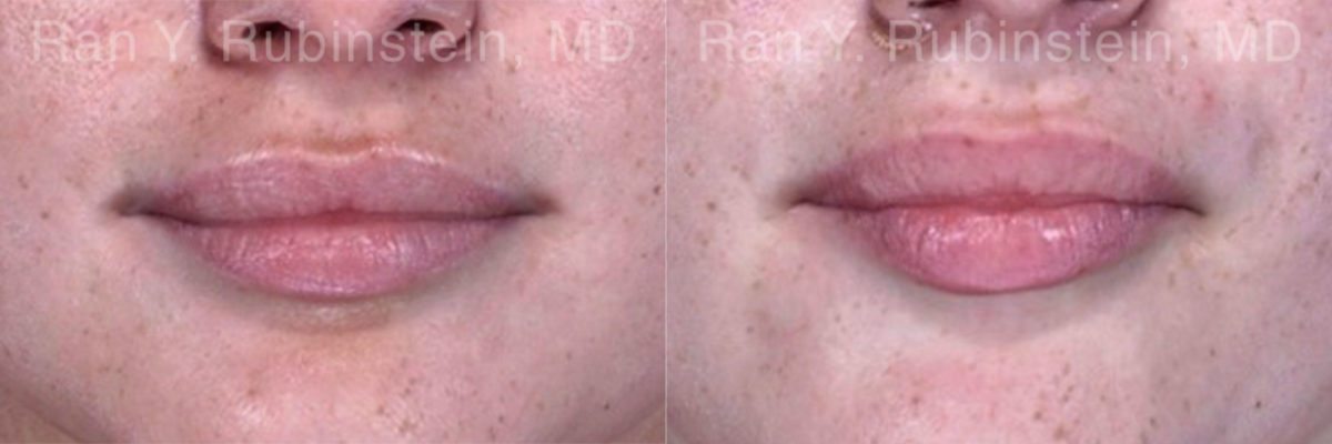 Lip Fillers Before and After Photos in Montvale, NJ, Patient 18436