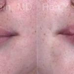 Lip Fillers Before and After Photos in Montvale, NJ, Patient 18436