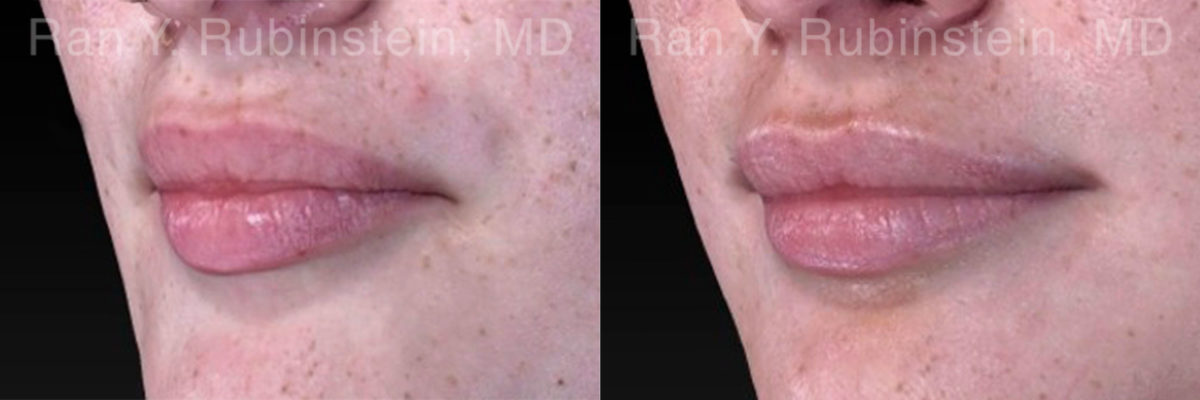 Lip Fillers Before and After Photos in Montvale, NJ, Patient 18436