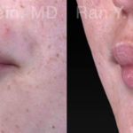 Lip Fillers Before and After Photos in Montvale, NJ, Patient 18436