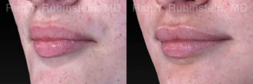 Lip Fillers Before and After Photos in Montvale, NJ, Patient 18436