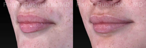 Lip Fillers Before and After Photos in Montvale, NJ, Patient 18436
