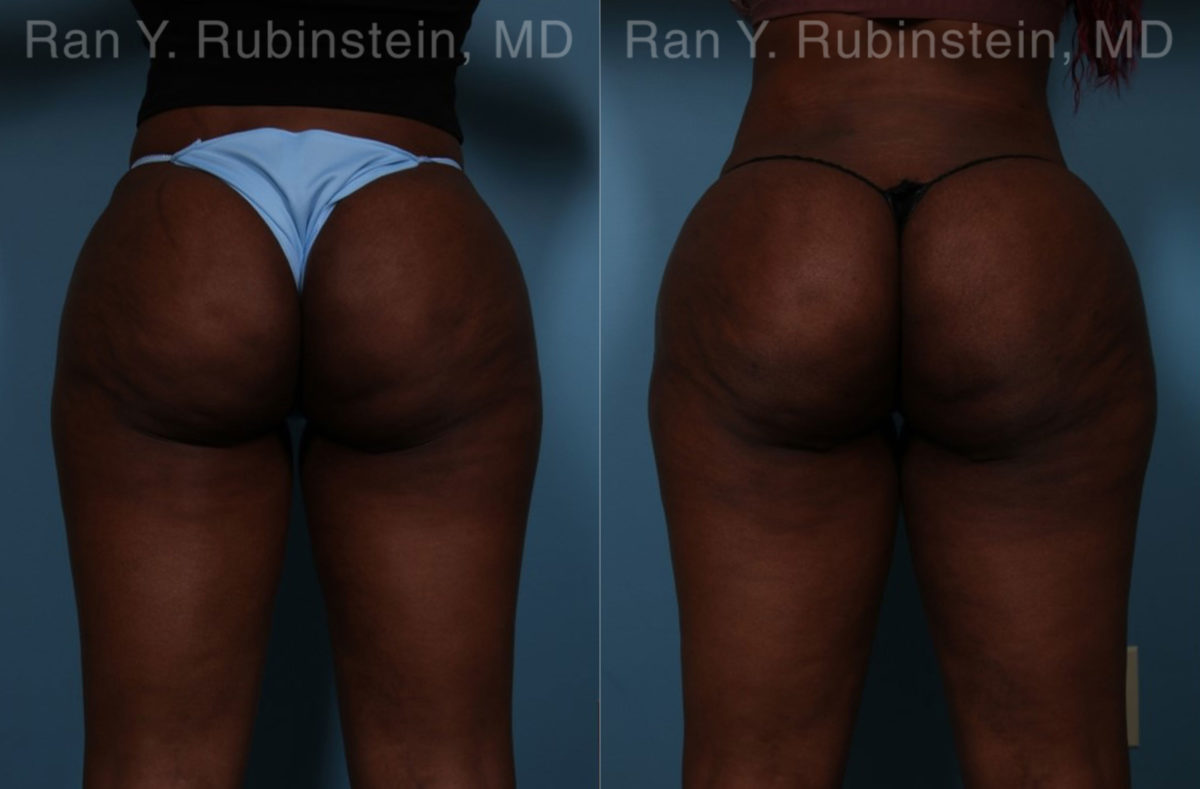 Sculptra Butt Lift Before and After Photos in Montvale, NJ, Patient 18453