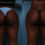 Sculptra Butt Lift Before and After Photos in Montvale, NJ, Patient 18453