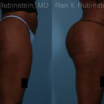 Sculptra Butt Lift Before and After Photos in Montvale, NJ, Patient 18453