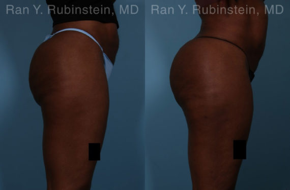 Sculptra Butt Lift Before and After Photos in Montvale, NJ, Patient 18453