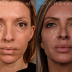 Sculptra Face Before and After Photos in Montvale, NJ, Patient 18887