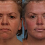 Face lift & Neck lift Before and After Photos in Montvale, NJ, Patient 18958