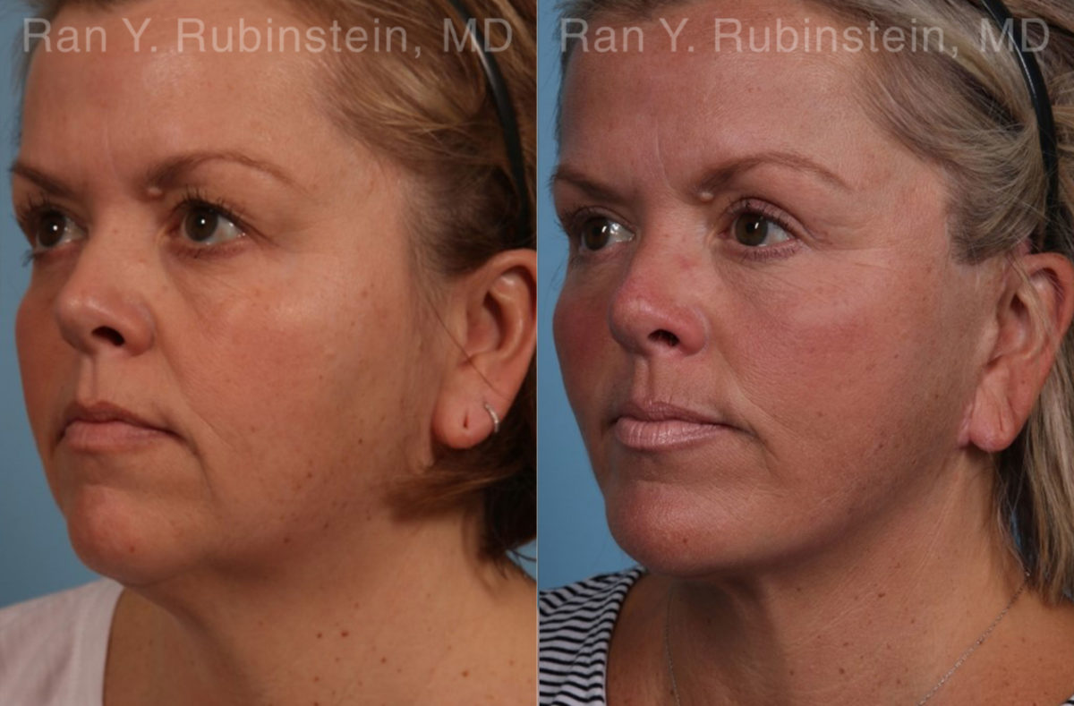 Face lift & Neck lift Before and After Photos in Montvale, NJ, Patient 18958