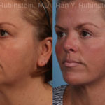 Face lift & Neck lift Before and After Photos in Montvale, NJ, Patient 18958