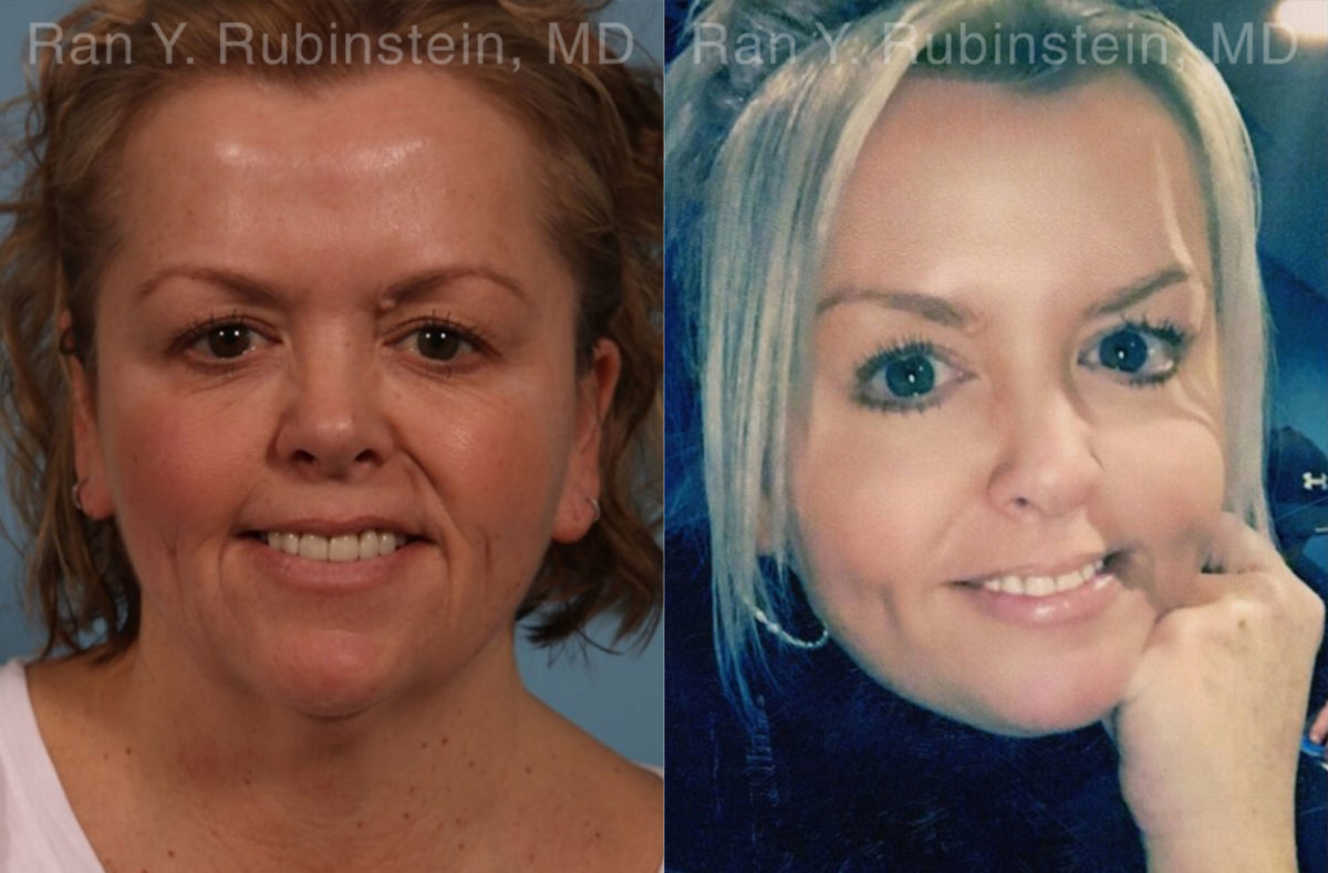 Face lift & Neck lift Before and After Photos in Montvale, NJ, Patient 18958