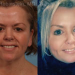 Face lift & Neck lift Before and After Photos in Montvale, NJ, Patient 18958