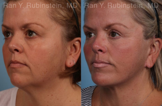 Face lift & Neck lift Before and After Photos in Montvale, NJ, Patient 18958