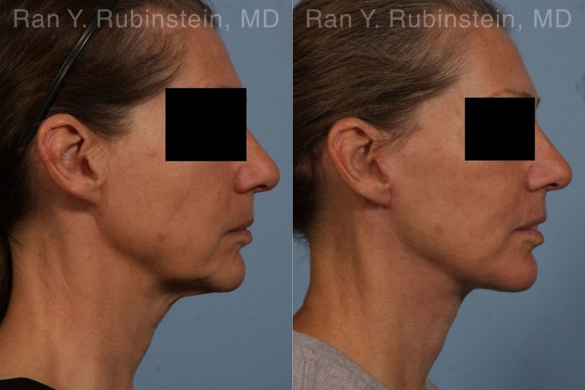 Face lift & Neck lift Before and After Photos in Montvale, NJ, Patient 18962