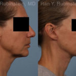 Face lift & Neck lift Before and After Photos in Montvale, NJ, Patient 18962