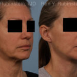Face lift & Neck lift Before and After Photos in Montvale, NJ, Patient 18962