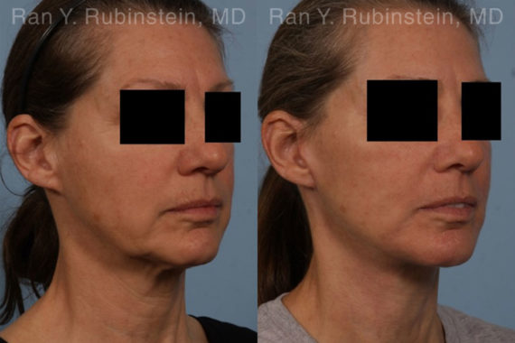 Face lift & Neck lift Before and After Photos in Montvale, NJ, Patient 18962