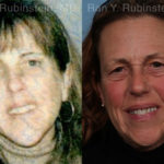 Dermal Fillers Before and After Photos in Montvale, NJ, Patient 18993