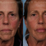 Dermal Fillers Before and After Photos in Montvale, NJ, Patient 18993