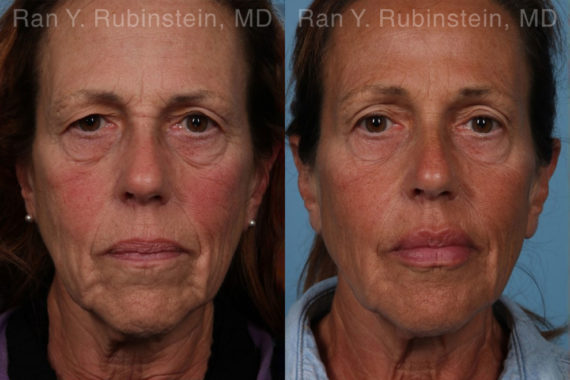 Dermal Fillers Before and After Photos in Montvale, NJ, Patient 18993