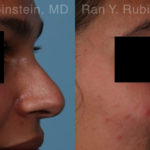 Non-Surgical Rhinoplasty Before and After Photos in Montvale, NJ, Patient 19009