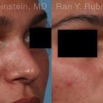 Non-Surgical Rhinoplasty Before and After Photos in Montvale, NJ, Patient 19009