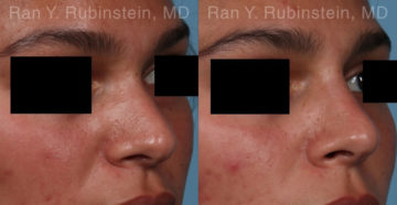 Non-Surgical Rhinoplasty Before and After Photos in Montvale, NJ, Patient 19009