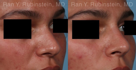 Non-Surgical Rhinoplasty Before and After Photos in Montvale, NJ, Patient 19009