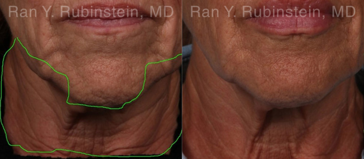 Botox Before and After Photos in Montvale, NJ, Patient 19026