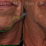 Botox Before and After Photos in Montvale, NJ, Patient 19026