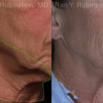 Botox Before and After Photos in Montvale, NJ, Patient 19026