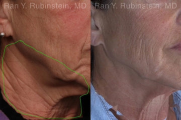 Botox Before and After Photos in Montvale, NJ, Patient 19026