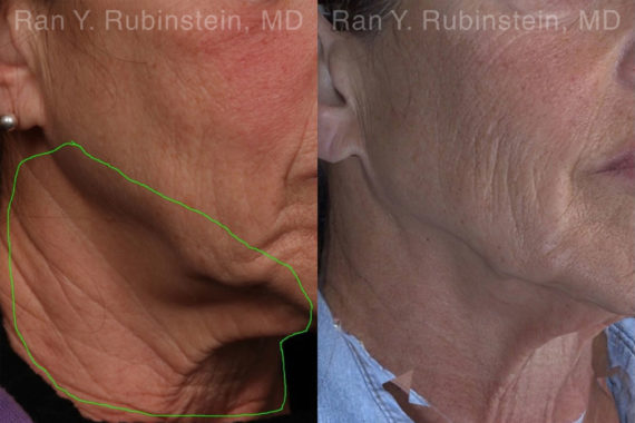Botox Before and After Photos in Montvale, NJ, Patient 19026