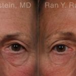 Botox Before and After Photos in Montvale, NJ, Patient 19033