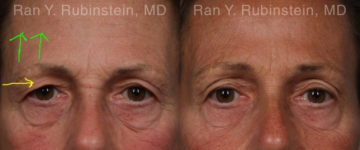 Botox Before and After Photos in Montvale, NJ, Patient 19033
