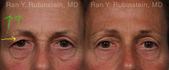 Botox Before and After Photos in Montvale, NJ, Patient 19033