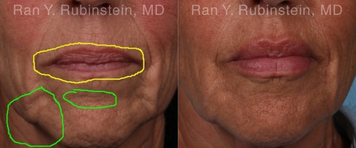 Lip Fillers Before and After Photos in Montvale, NJ, Patient 19037
