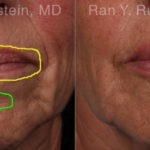 Lip Fillers Before and After Photos in Montvale, NJ, Patient 19037